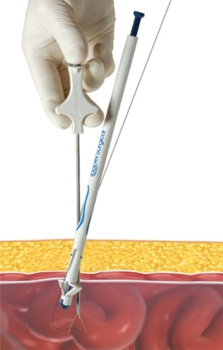 Carter-Thomason® II  Port Closure System